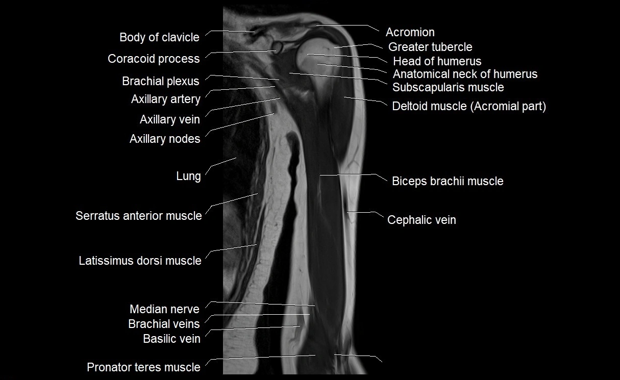 MRI upper arm (humerus ) coronal cross sectional anatomy image 9.webp